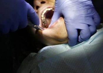 Unimaginable, doctors remove 526 teeth from a 7-year-old’s mouth
