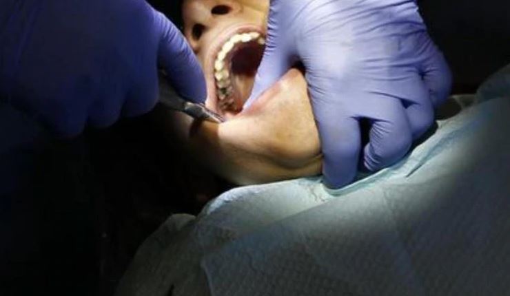 73 percent children in Kathmandu Valley face tooth decay problems