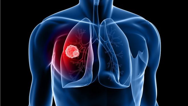 4 common lung cancer myths you should know