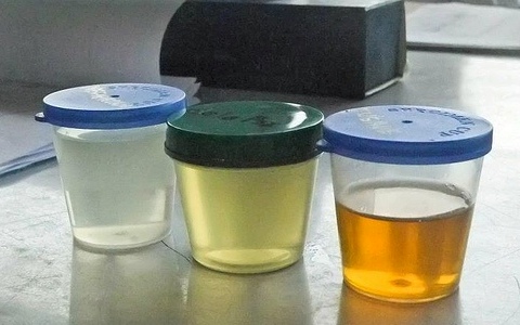 Know about your urine color and effects