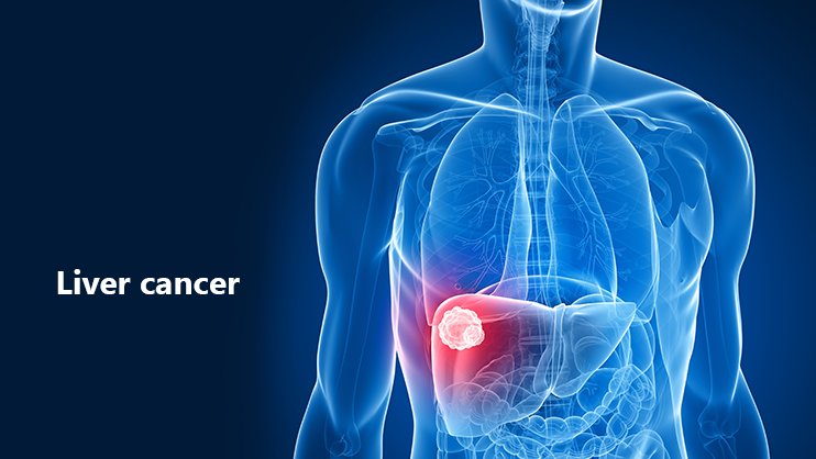 Liver cancer deaths 50% up in last 10 years