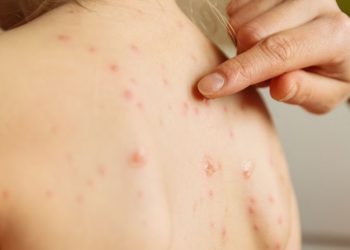 Measles continues to spread in Banke