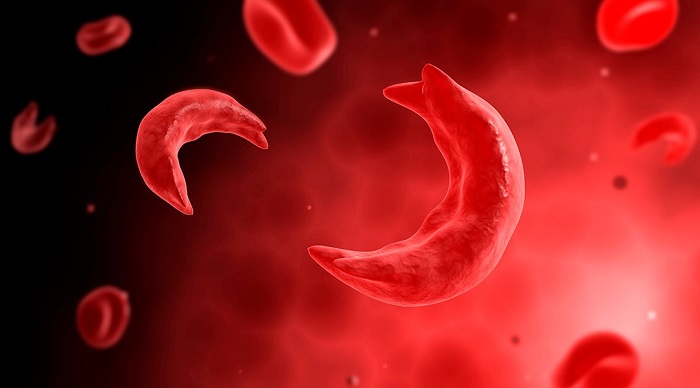 339 sickle cell anemia patients in Dang