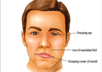 Bell’s palsy explained