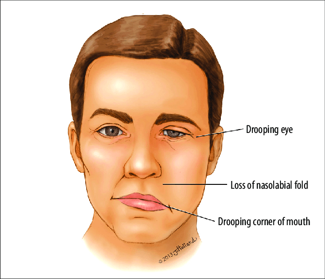 Bell’s palsy explained