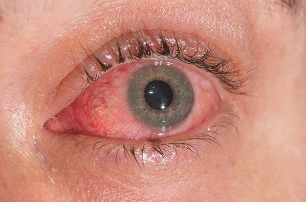 Conjunctivitis cases surge; half of hospital visitors show infection