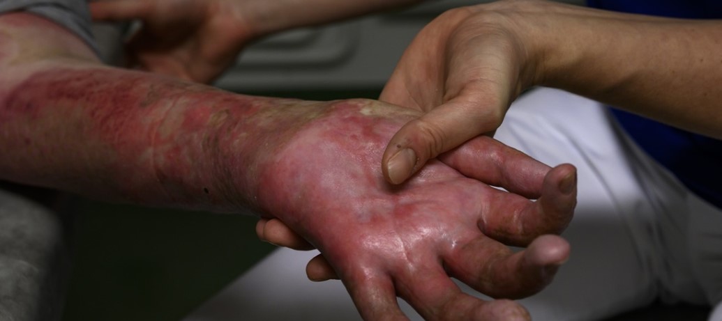 Understanding Burns: Risk, Prevention and First Aid