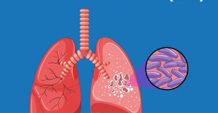 World Tuberculosis Day: Things to know about TB
